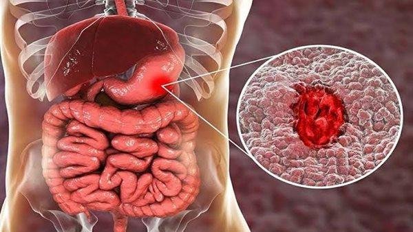 المرض الصامت الذي يصيب الشباب.. تعرف على الأعراض وأحدث طرق العلاج والوقاية