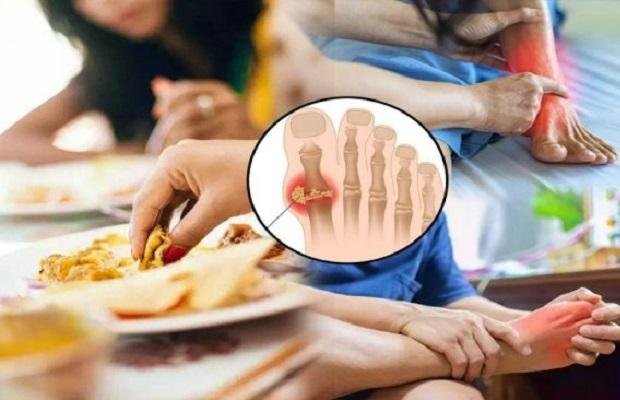حمض اليوريك .. أطعمة ومشروبات تزيد من مخاطره