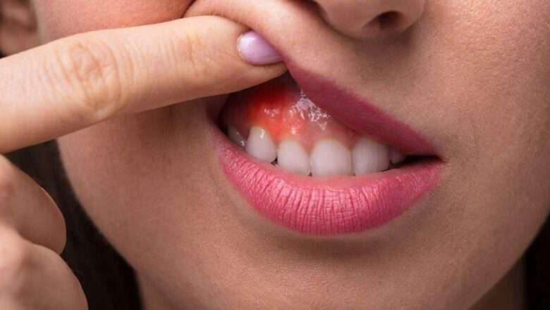 طريقة لمحاربة إلتهابات الفم بشكل أمن وطبيعي
