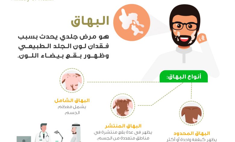 ما هو البهاق وما أنواعه ؟ وزارة الصحة تجيب على ذلك