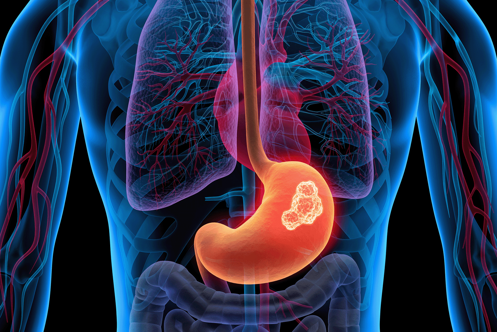 «هل تؤثر أدوية الحموضة على خطر الإصابة بسرطان المعدة؟»