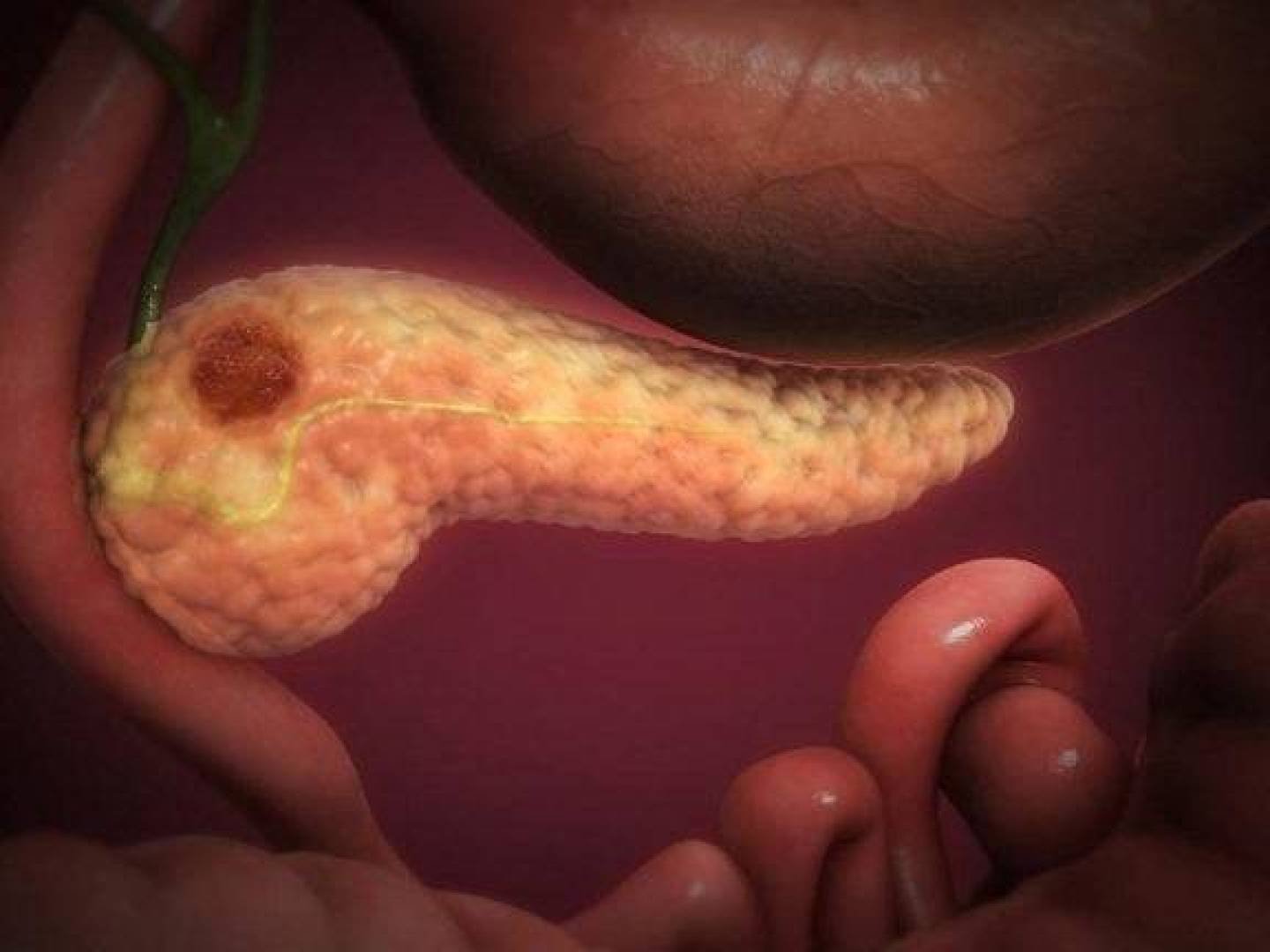 «شراسة سرطان البنكرياس وصعوبة علاجه: تفسير طبي علمي»