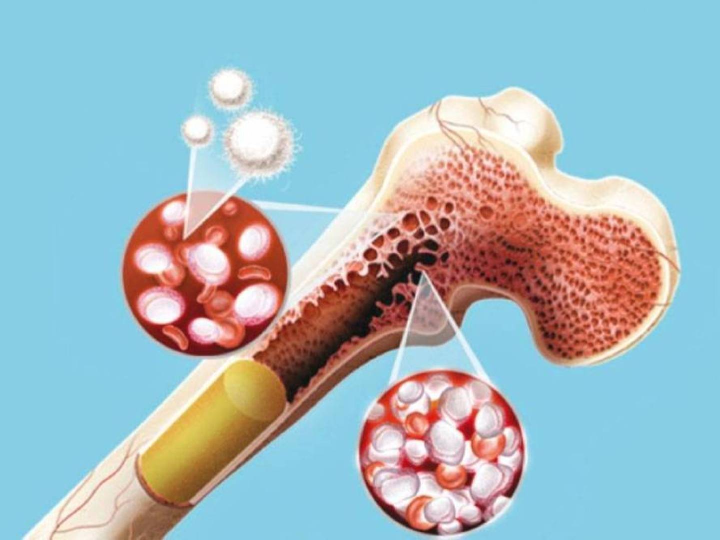أداة متطورة تتنبأ بخطر تحول الأمراض الدموية إلى سرطان