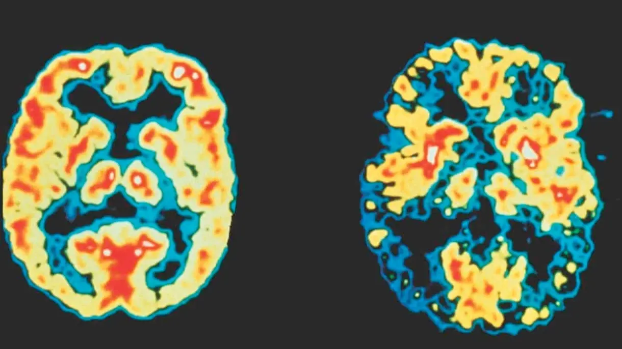 زيادة جزيئات البلاستيك في دماغ مرضى الخرف بخمسة أضعاف