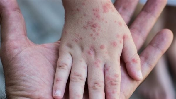 «حماية صحة الأطفال» بريطانيا تمنع دخول غير الملقحين ضد الحصبة إلى المدارس