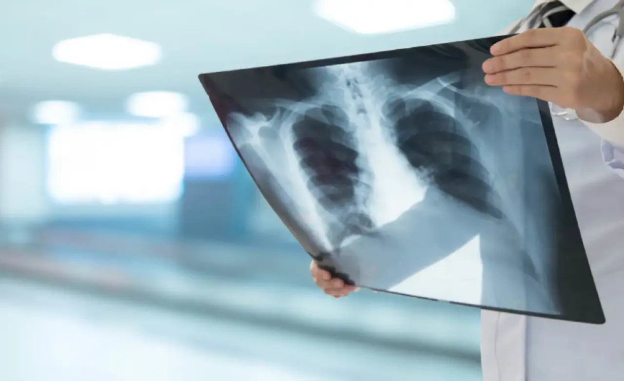 تحذير لمتعافي كوفيد-19 حول زيادة مخاطر الإصابة بسرطان الرئة