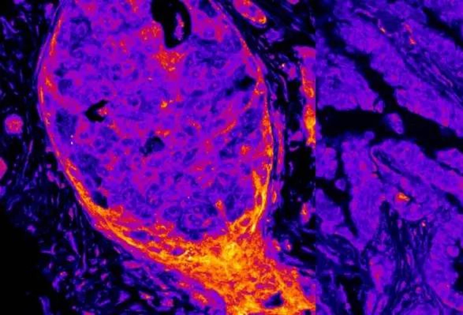 «اكتشاف بصمة أيضية نووية فريدة للسرطان قد تحدث ثورة في طرق العلاج»