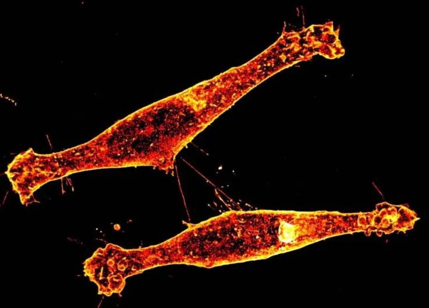 آلية انتشار مرض هنتنغتون في الدماغ تفتح أفقًا جديدًا في الأبحاث العلمية