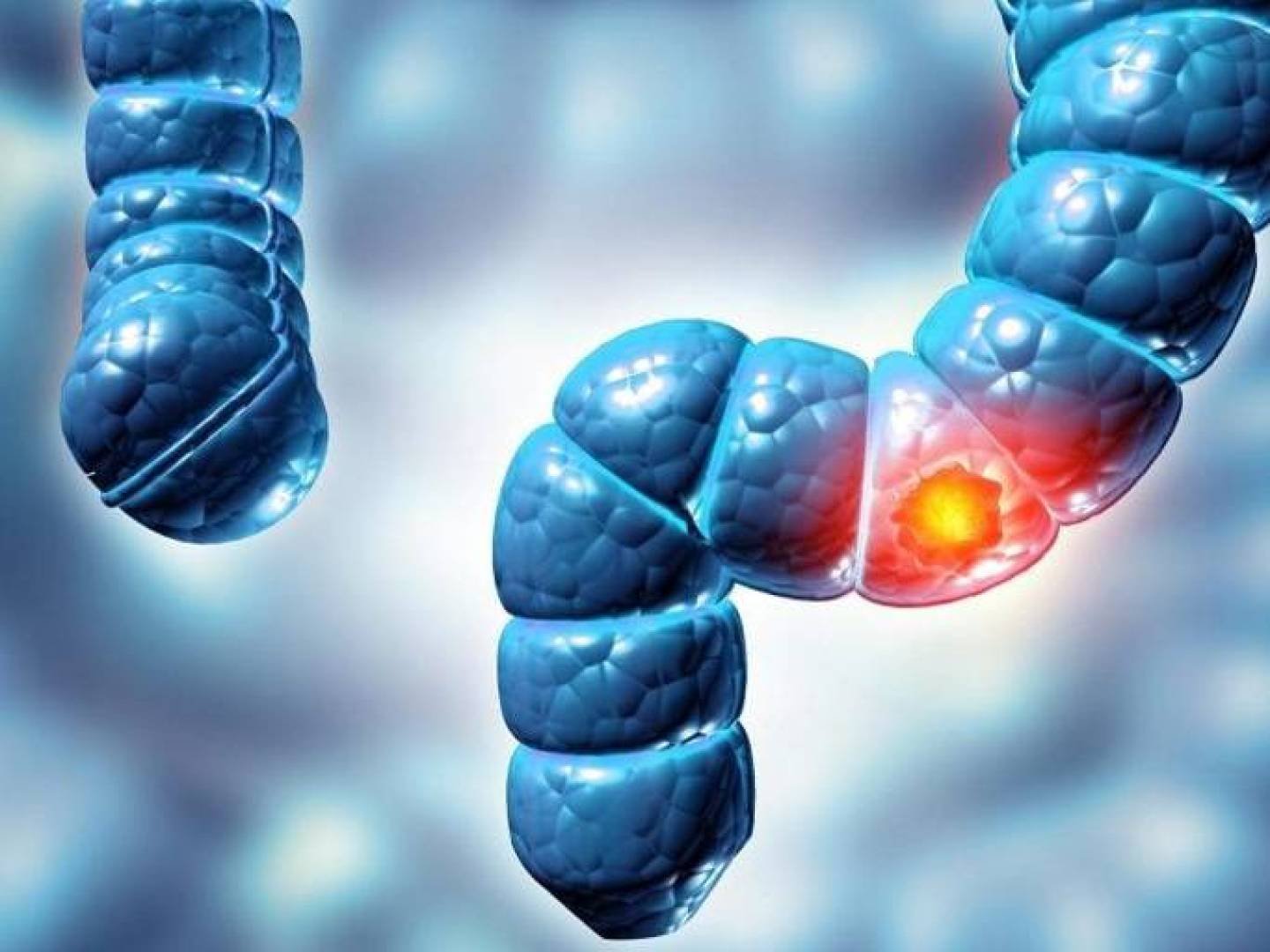 اكتشاف فيروس غير معروف يعزز الصلة بسرطان القولون والمستقيم